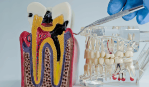 Dentist in South Edmonton at Petrolia Dental Edmonton demonstrating tooth decay prevention techniques during patient consultation