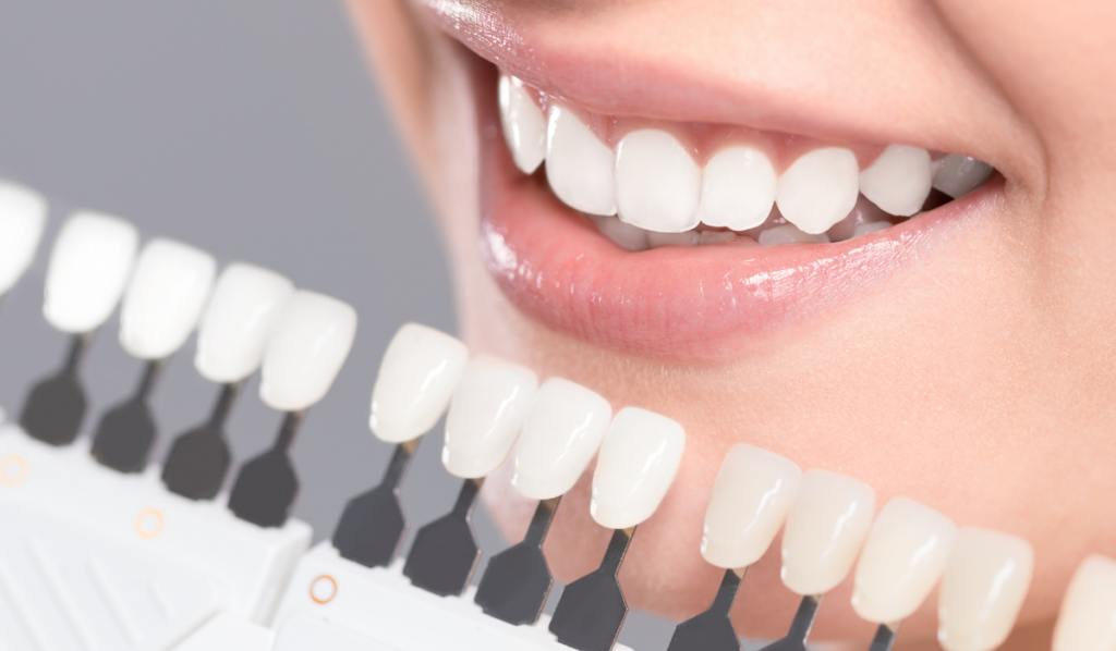 Dentist in North West Edmonton at Petrolia Dental Edmonton performing professional teeth whitening treatment showing dramatic results